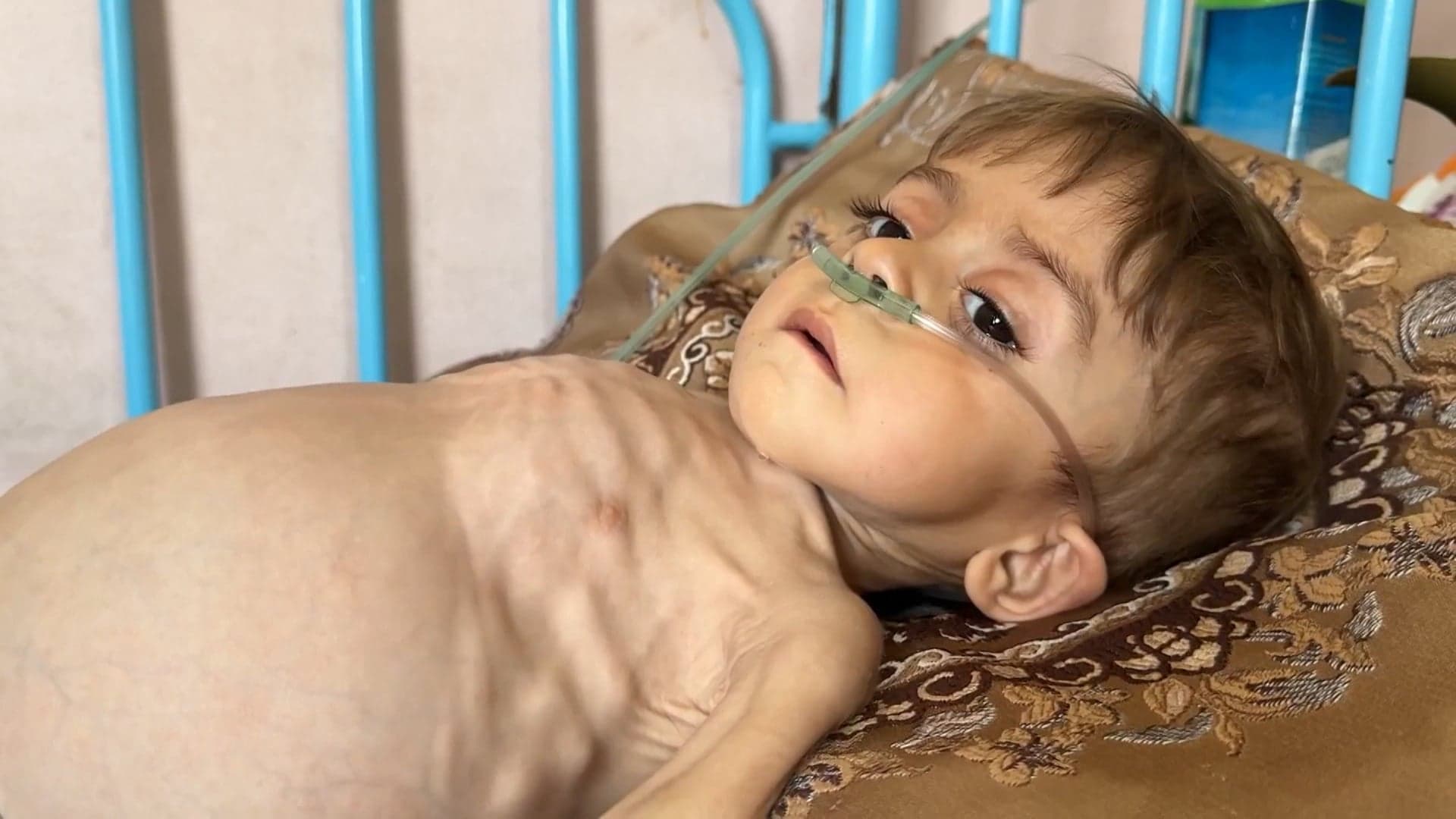 أطفال غزة بين المرض والمجاعة: قصة كريم أبو معمر